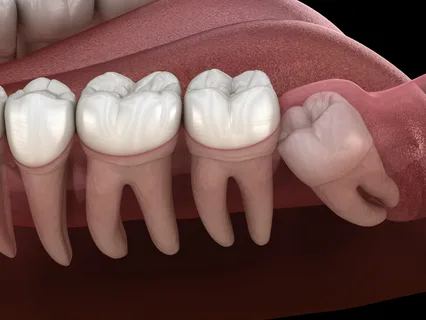 wisdom teeth removal Alexandria